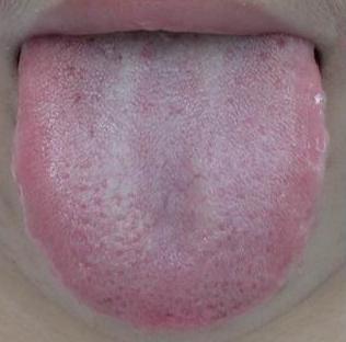 吃瓜舌头刺痛出血,揭秘吃瓜时的意外惊魂